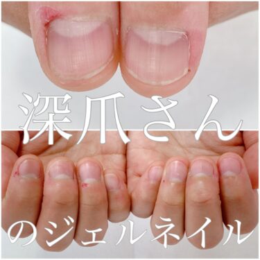 【沖縄県】で深爪にお悩みの女性におすすめのネイルサロン